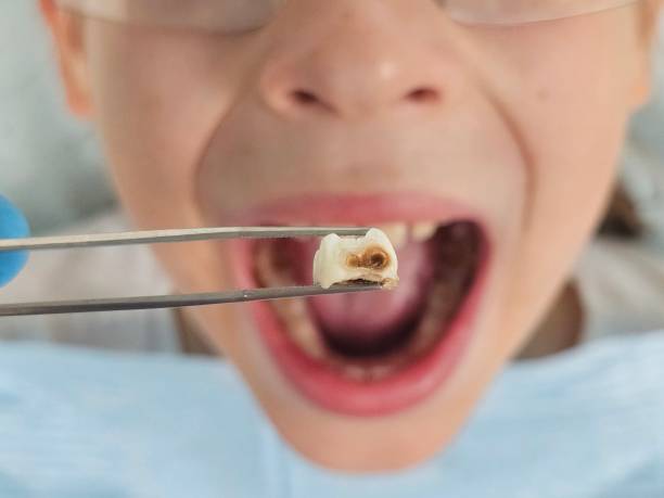 Best Emergency Tooth Extraction in Clarcona, FL
